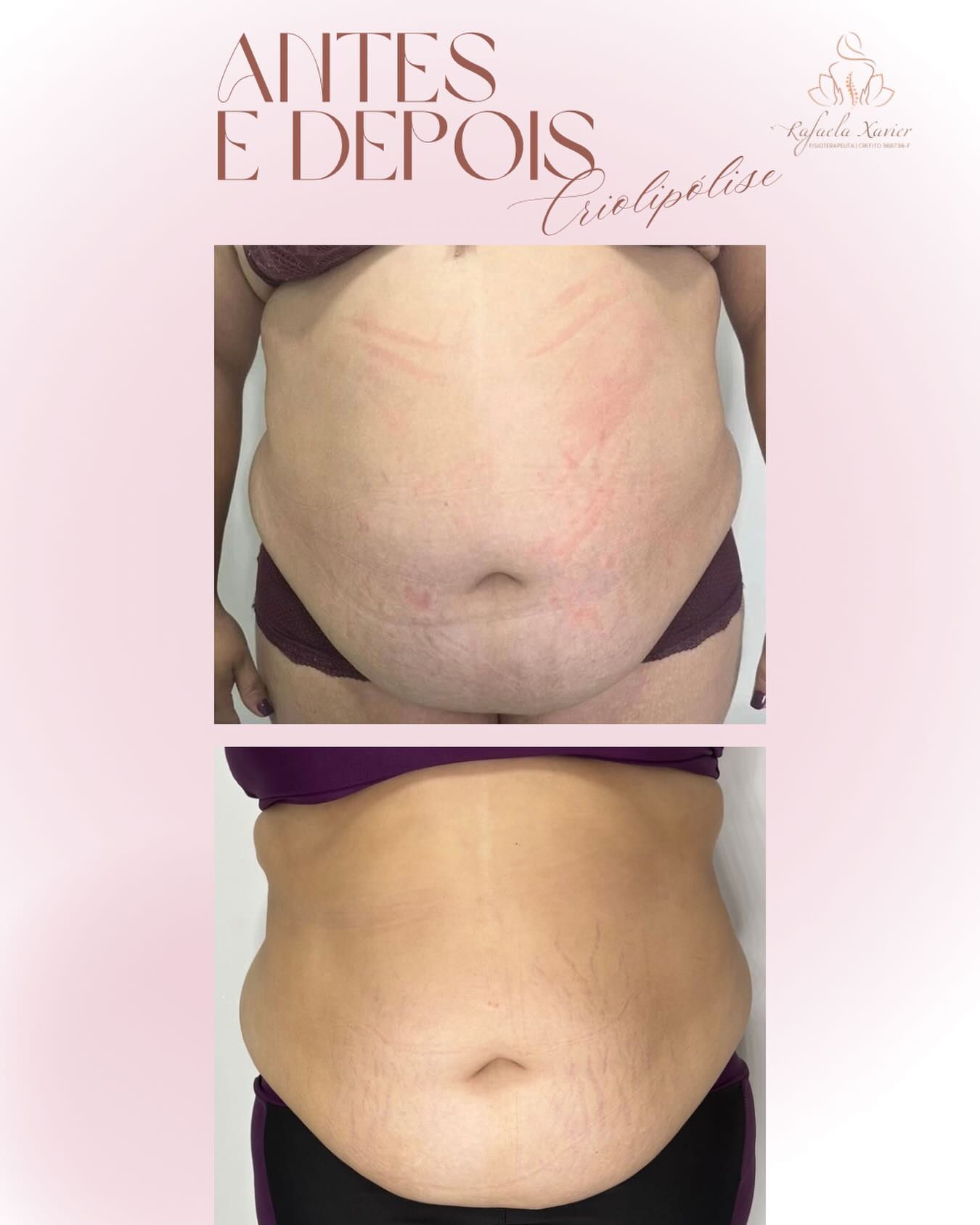 Procedimento de estética corporal com a Dra. Rafaela Xavier